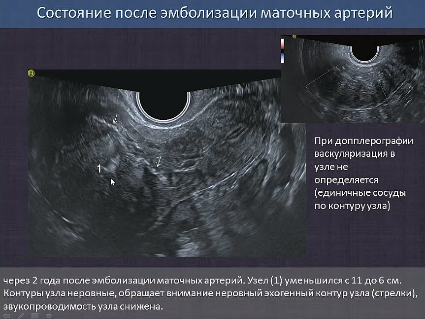 Эмболизация маточных артерий при миоме матки отзывы. После эмболизации маточных артерий. Осложнения после эмболизации маточных артерий. УЗИ после эмболизации маточных артерий.